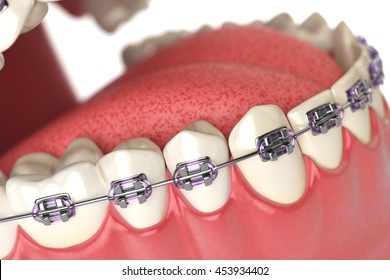 Teeth With Braces Or Brackets In Open Human Mouth. Dental Care Concept. 3d Illustration