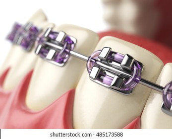 Teeth With Braces Or Brackets In Open Human Mouth. Dental Care Concept. 3d Illustration