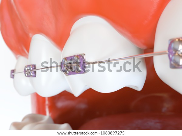 braces brackets