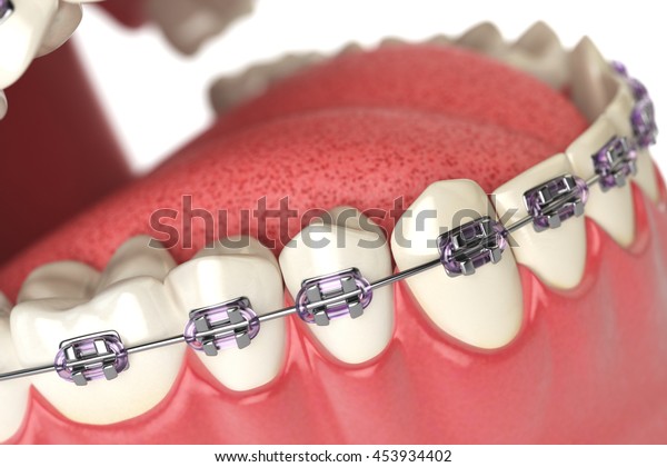 人の口の中にブレースまたはブラケットを持つ歯 歯科ケアのコンセプト 3dイラスト のイラスト素材