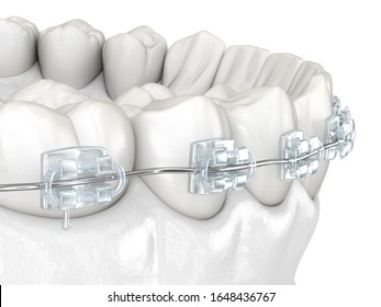 Teeth And Clear Braces. Medically Accurate Dental 3D Illustration