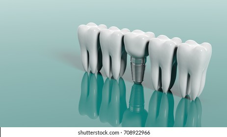 Zähne und Zahnimplantate einzeln auf grünem Hintergrund. 3D-Illustration