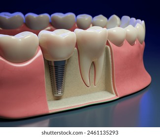 Teeth and implant in gums 3D render