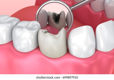 Teeth Inspection Mirror Medically Accurate Tooth Stock Illustration 