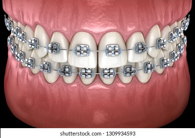 23,101 Metallic braces Images, Stock Photos & Vectors | Shutterstock