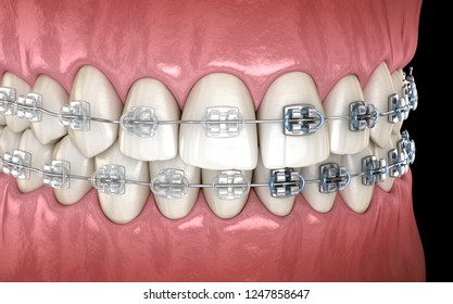 Teeth Clear Braces Gums Medically Accurate Stock Illustration 1254136216