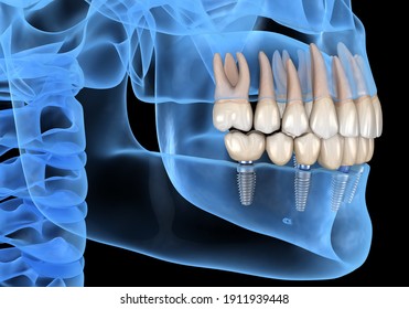 Teeth recovery with implant, x-ray view. Medically accurate 3D illustration of human teeth and dentures concept