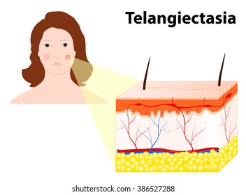 Telangiectasias. Spider Veins Or Angioectasias. Veins On The Face