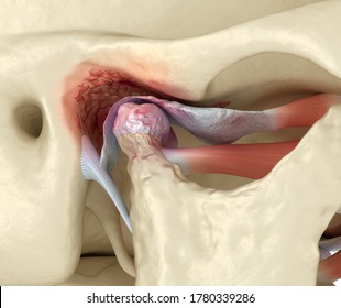 Temporomandibular Joints Arthritis And Dislocated Articular Disc. Medically Accurate 3D Illustration.