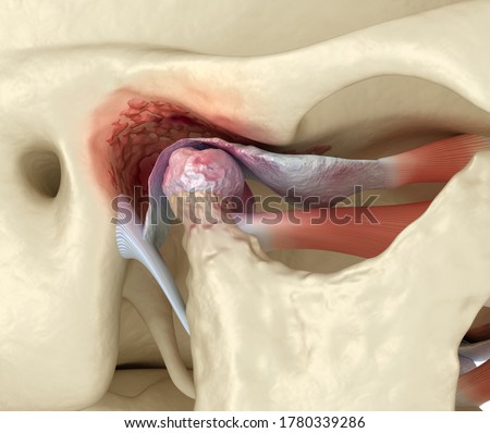 Temporomandibular joints arthritis and dislocated articular disc. Medically accurate 3D illustration. Stock photo © 