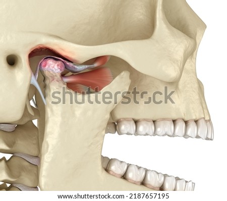Temporomandibular joints arthritis and dislocated articular disc. Medically accurate 3D illustration. Stock photo © 