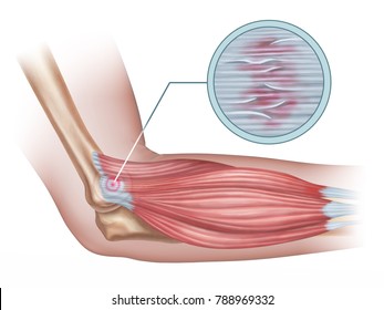 Tennis elbow diagram showing a detail of the damaged tendon tissue. Digital illustration.