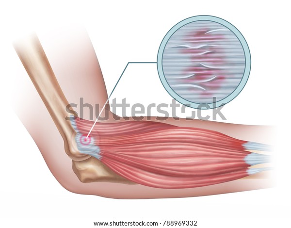 Tennis elbow diagram showing a\
detail of the damaged tendon tissue. Digital\
illustration.