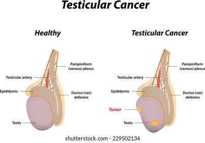 Testicular Cancer