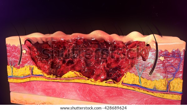 Third Degree Burn 3d Illustration Stock Illustration 428689624