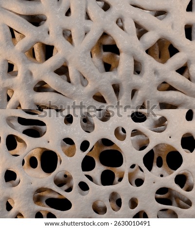 This 3d illustration shows the bone thinning caused by osteoporosis
