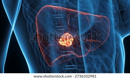This 3D x-ray view shows liver cancer in a female, wide angle anterior view, highlighting abnormal growth, semi-transparent against a solid black background.