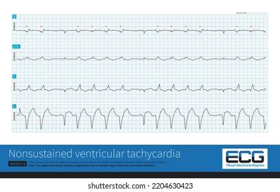 593 Cardiac monitor tachycardia Images, Stock Photos & Vectors ...