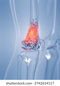 This glass render illustrates osteosarcoma affecting a human male's knee bone, set against a solid background.