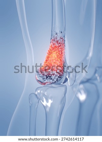 This glass render illustrates osteosarcoma affecting a human male's knee bone, set against a solid background.