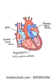 This Heart Surgery Right Side Hypoplastic Stock Illustration 2093935396