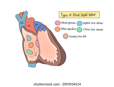 This Picture Show 5 Type Of Interatrial Septal Defect When Look Though The Right Atrium Of Heart.