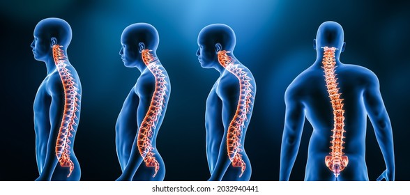 Three main curvatures of the spine disorders or deformities on male body: lordosis, kyphosis and scoliosis 3D rendering illustration. Human anatomy, back injury or disease, medical concepts.