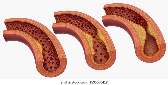 Three stages of arterial disease in atherosclerosis, with accumulation of cholesterol and fat in the walls, schematic and descriptive illustration.