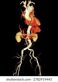 Three-dimensional computed tomography (CT) scan of the human aorta showing an aneurysm, severe atherosclerosis, and calcification. Ideal for medical, educational, and healthcare concepts.