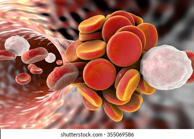 Thromboembol In Blood Vessel. Clot Formation. Red Blood Cells And White Blood Cells.