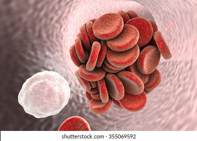 Thromboembol In Blood Vessel. Clot Formation. Covid-19 Complication. Thromboembolism. Pulmonary Embolism, Brain Stroke, Coronary Artery Thrombosis In Myocardial Infarction, 3D Illustration