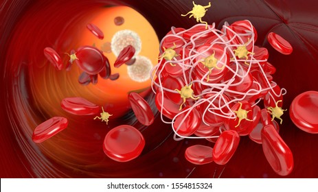 Thrombosis, blood-clot, bloodstream, red blood cells, erythrocytes, activated platelets, fibrin, thrombosis, medical illustration, 3D