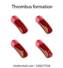 Thrombus Formation. Stages. Medical Anatomy Illustration.