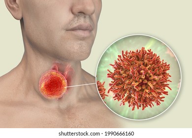 Thyroid Cancer. 3D Illustration Showing Thyroid Gland With Tumor Inside Human Body And Closeup View Of Thyroid Cancer Cells