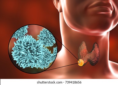 Thyroid Cancer. 3D Illustration Showing Thyroid Gland With Tumor Inside Human Body And Closeup View Of Thyroid Cancer Cells