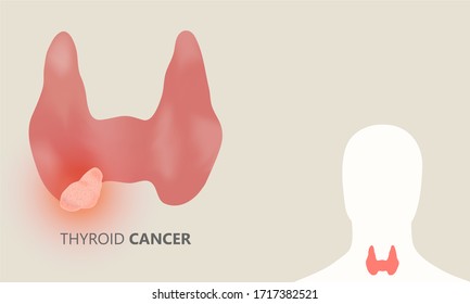 Thyroid Cancer Symptoms Hd Stock Images Shutterstock