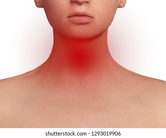 Thyroid Gland Exposed On The Neck Of A Woman With Endocrine Disruption, Inflammation And Swelling. Endocrine System Disease. 3D Illustration