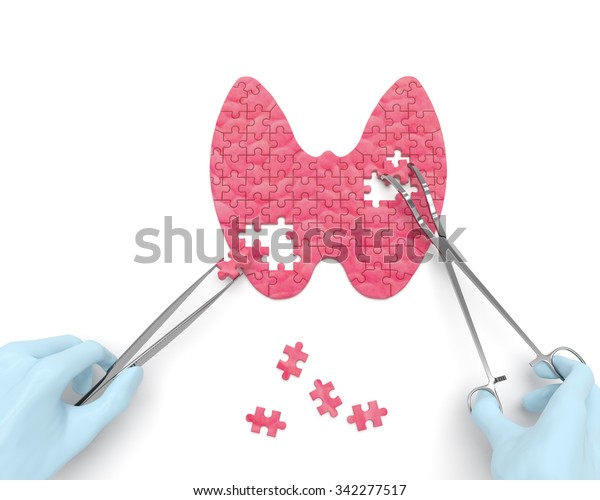 甲状腺パズルのコンセプト 甲状腺機能低下症 甲状腺腫 甲状腺腺炎 甲状腺甲状腺腫 甲状腺甲状腺甲状腺腫 ヨウ素欠乏の結果として甲状腺 手術を行う外科器具 ツール を持つ外科医の手 のイラスト素材