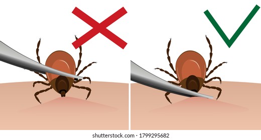 A Tick Is Removed From The Skin With Tweezers. Tick Bite