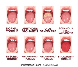 77 Leukoplakia Images, Stock Photos & Vectors | Shutterstock