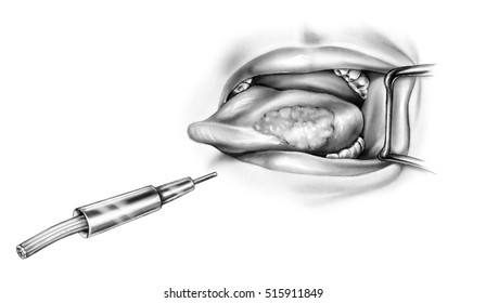 Tongue Cancer Laser Treatment Stock Illustration 515911849 | Shutterstock