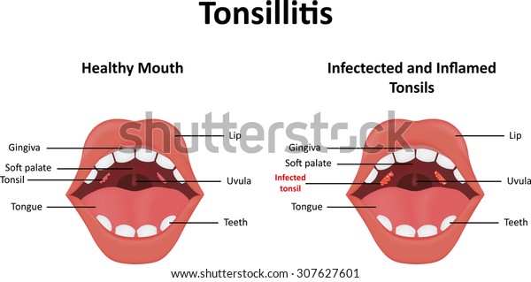 Tonsillitis Stock Illustration 307627601