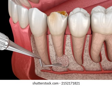 Tooth Cystectomy Surgery - Recovery After Periostitis . Dental 3D Illustration