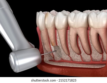 Tooth Cystectomy Surgery - Recovery After Periostitis . Dental 3D Illustration