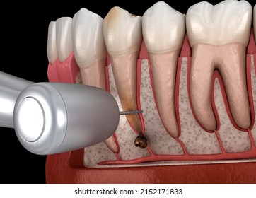 Tooth Cystectomy Surgery - Recovery After Periostitis . Dental 3D Illustration