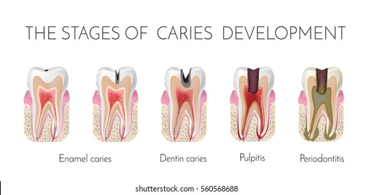 dental caries process