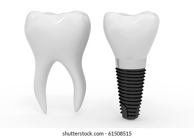 Tooth And Dental Implant