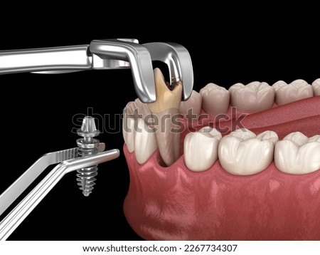 Tooth extraction and implantation, complex immediate surgery. Dental 3D illustration