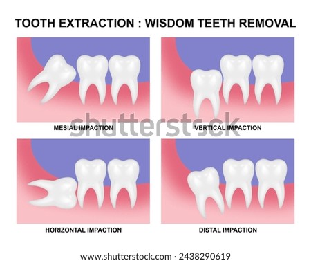 Tooth extraction wisdom tooth removal