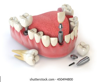 Tooth human implant. Dental concept. Human teeth or dentures. 3d illustration